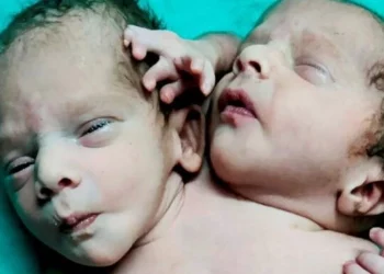 En la India El bebé que espera el milagro: nació con dos cabezas, tres manos y dos corazones