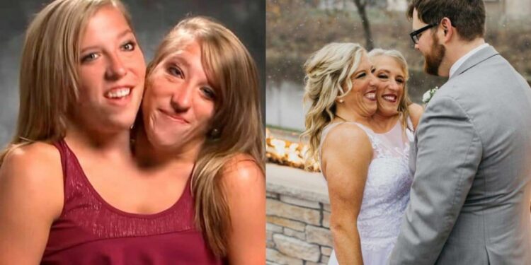 Una de las siamesas Hensel se casó y genera controversia en las redes sociales: ¿Cómo es su vida íntima?